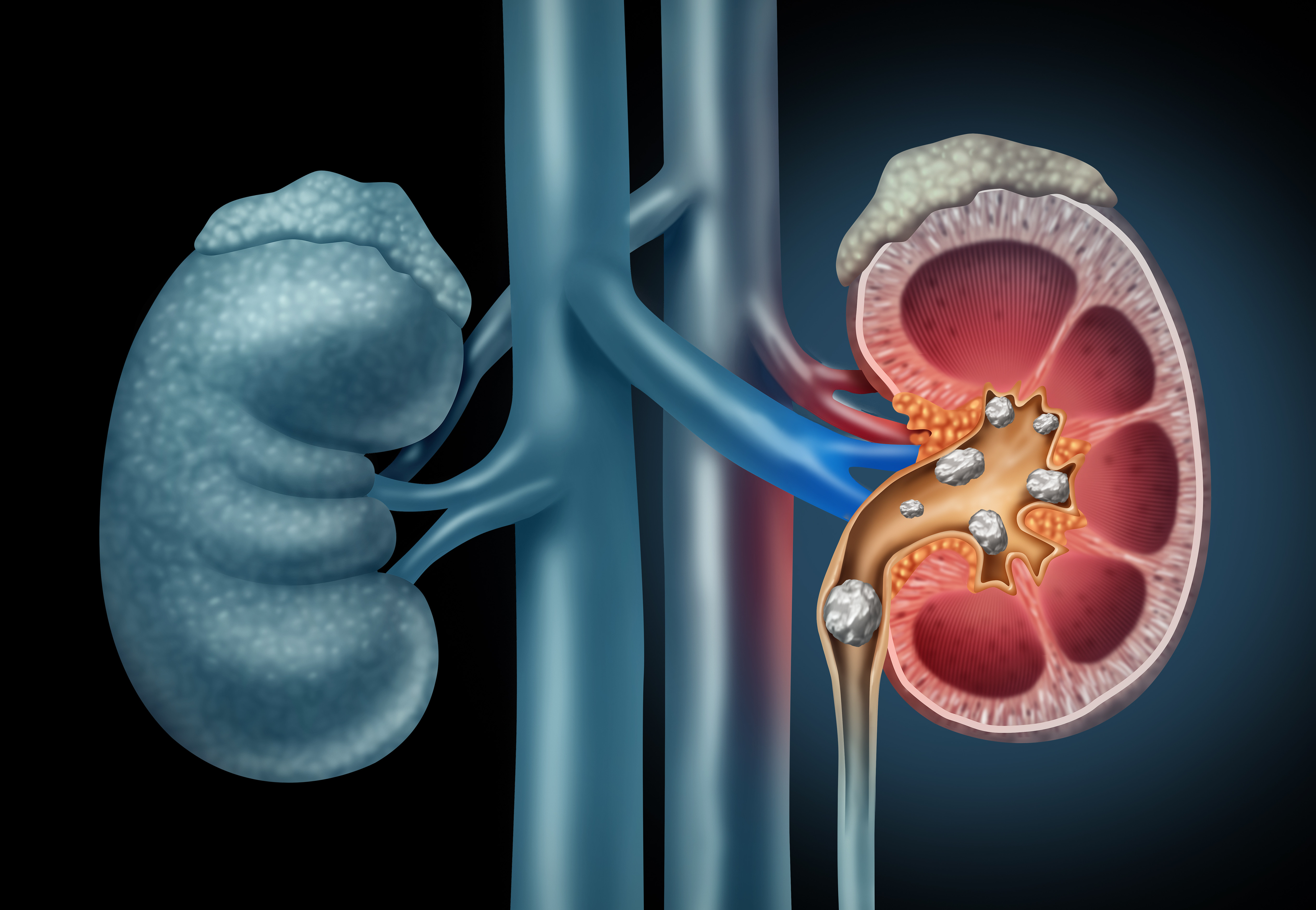 Kidney Calculi Ayurveda Treatment